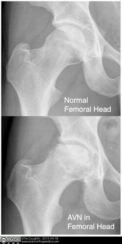 Avascular Necrosis Femoral Head - Physiopedia