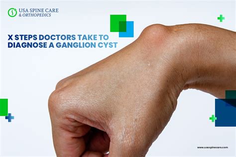 Six Steps Doctors Take to Diagnose a Ganglion Cyst - USA Spine Care - Laser Spine Surgery