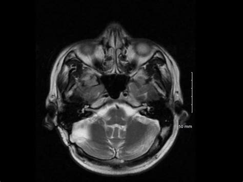 T2 weighted MRI axial image showing right cerebellar gliosis related to... | Download Scientific ...