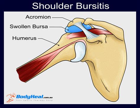 Shoulder Bursa Anatomy - Anatomical Charts & Posters