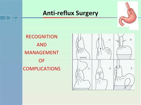 Complications Following Antireflux Surgery: Recognition and Management