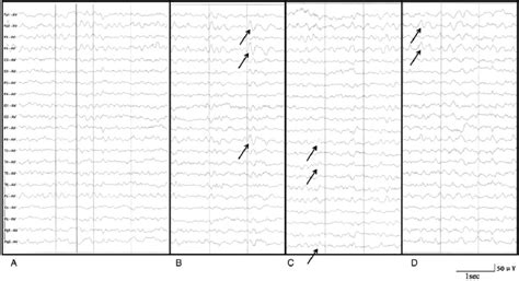 The a rhythm was not obvious, and the u wave was increased in the ...