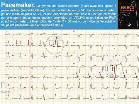 Pacemaker 3. Signes ECG : e-cardiogram