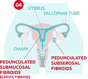 How Fibroids Are Measured