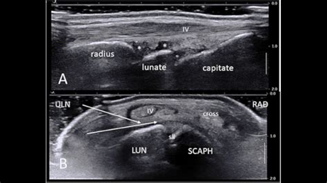 Arthrocentesis of the Wrist Joint - Internet Book Of MSK Ultrasound