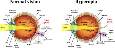 Can Laser Eye Surgery Correct Farsighted Vision? : Silverstein Eye Centers