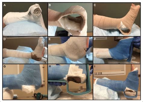 Technique for applying the modified short-leg splint/cast with... | Download Scientific Diagram