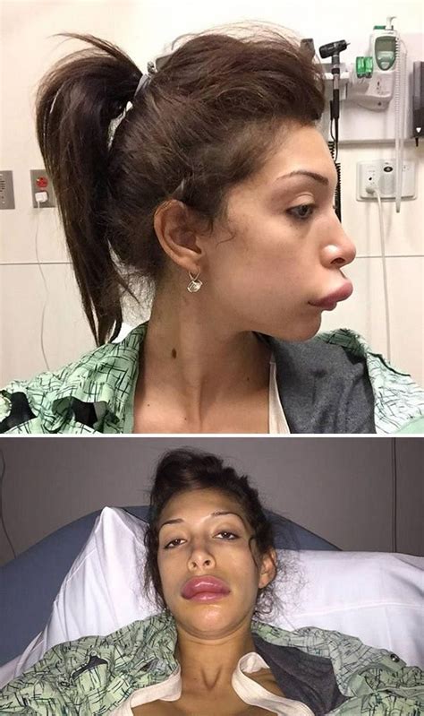 The reality star who landed in the ER after her lip injections left her ...