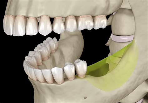 Jawbone Loss Phoenix AZ | Jawbone Deterioration Scottsdale AZ