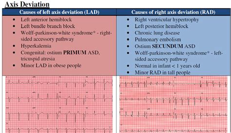 Axis Deviation Ekg Practice