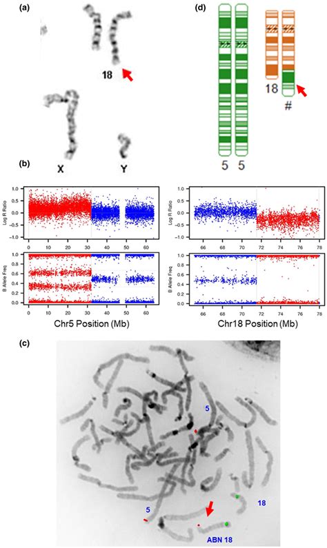 Cytogenetic analysis. (a) Karyotype shows the addition of unknown... | Download Scientific Diagram