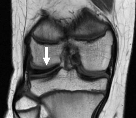 Discoid Meniscus - OrthoInfo - AAOS