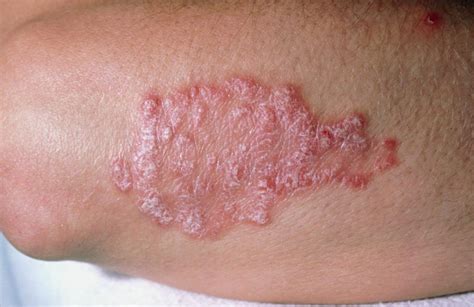 Psoriasis | Causes, Triggers, Diagnosis & Treatment