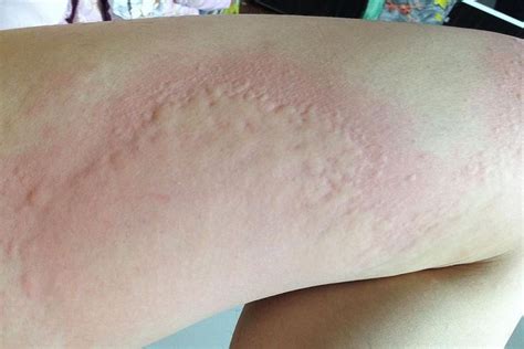 Hives: Common Rash With Many Possible Causes | Urticaria, Allergy remedies, Cold urticaria