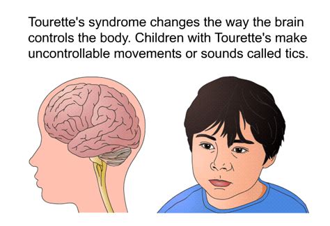 PatEdu.com : Tourette's Syndrome