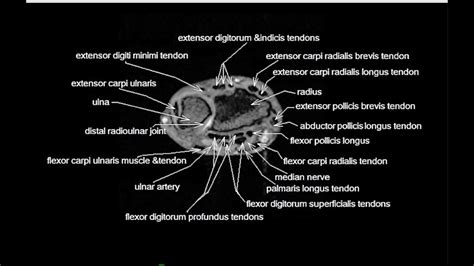 MRI Read wrist joint axial view||cross sectional Anatomy of wrist joint ...