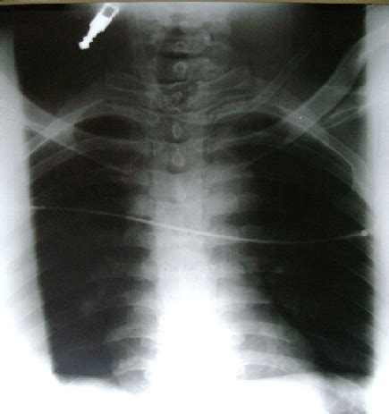 and 2: X ray of the thoracic spine shows communited fracture of the... | Download Scientific Diagram