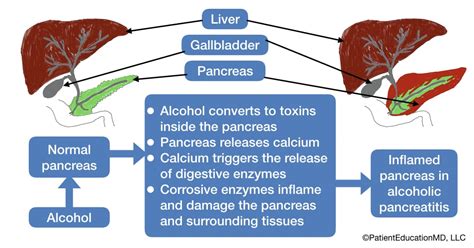 Alcoholic pancreatitis - PatientEducationMD