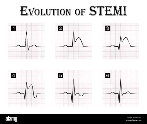 Ecg Of St Elevation Myocardial Infarction Stemi Vector Image | Porn Sex ...