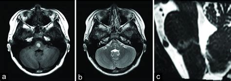 Surgical Neurology International