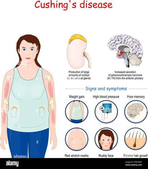 Cushing's disease. Signs and symptoms of Cushing syndrome. Vector ...