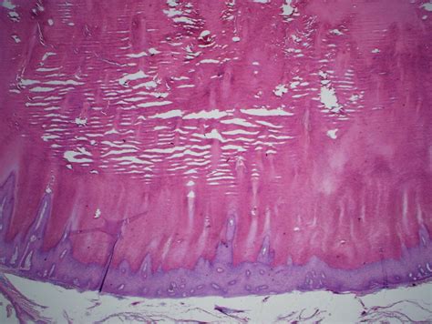 Pathology Outlines - Cutaneous horn