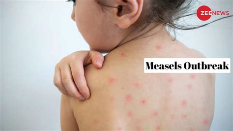 Measles Outbreak: Understanding Symptoms, Prevention And Treatment | Health News | Zee News