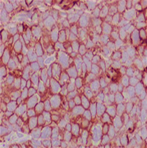 Immunophenotype features (x400) suggesting of large neoplastic lymphoid... | Download Scientific ...