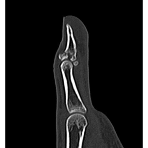 Computed tomography shows an avulsion fracture at the base of the ...