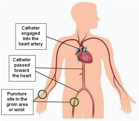 Coronary Angiogram Anatomy - Anatomical Charts & Posters