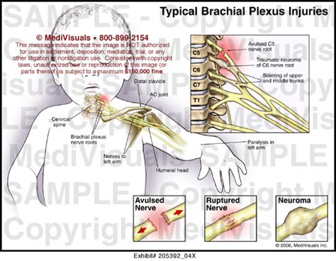 Typical Brachial Plexus Injuries Medical Illustration Medivisuals