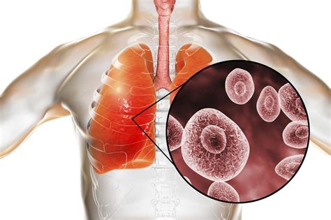 Pneumocystis Pneumonia Associated With Higher Mortality in Lung ...