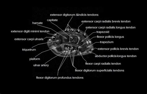 mri anatomy wrist hand - Google Search | Wrist anatomy, Anatomy images ...