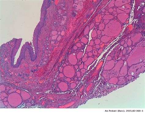 Thyroid Cyst Histology