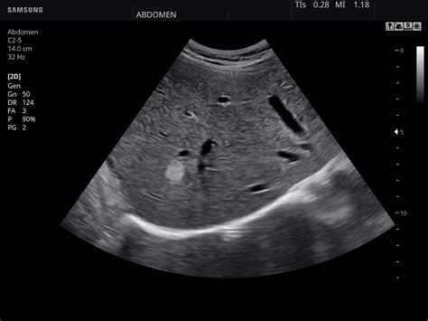 Ultrasound images - Liver, B-mode, echogramm №847