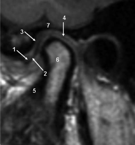 Tmj Mri Anatomy