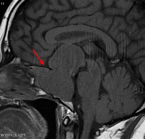 Pituitary adenoma causes, symptoms, diagnosis, treatment & prognosis