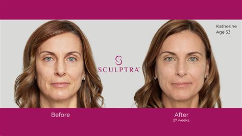 Sculptra: The Ultimate Anti-Ageing Treatment. All You Need to Know