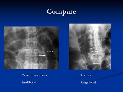 haustra vs valvulae conniventes - Google Search | Large bowel, Obstetrics, Bowels