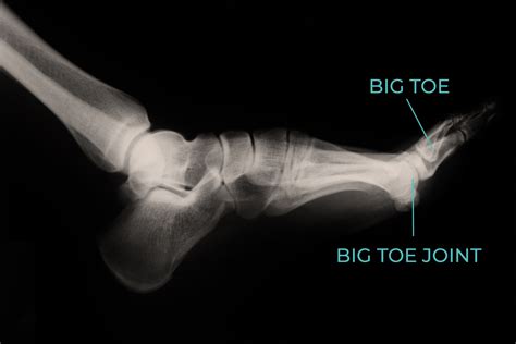 Turf Toe Injury Recovery | The Foot Practice Podiatry Singapore