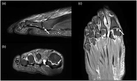 Clinical and imaging assessment and treatment of hallux valgus - Nathan Heineman, George Liu ...