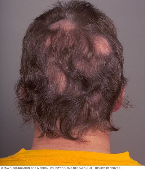 Nutrafol and Hair Loss - Alamo Heights Dermatology