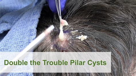 Double the Trouble Pilar Cysts | Dr. Derm - Pimple Popping Videos