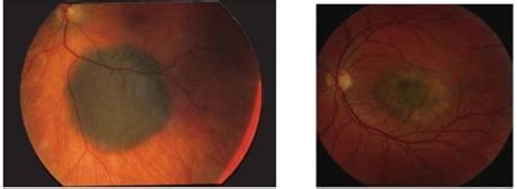 Understanding Choroidal Nevi