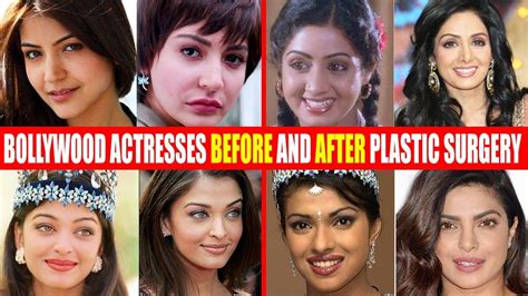 Indian Celebrity Botox Before And After