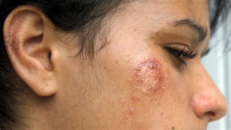 Do You Have Impetigo? 8 Facts to Know