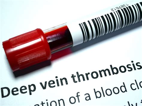 What Causes Deep Vein Thrombosis? - Delaware Vein Center