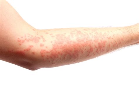 Hives (urticaria): Causes, treatment, and symptoms