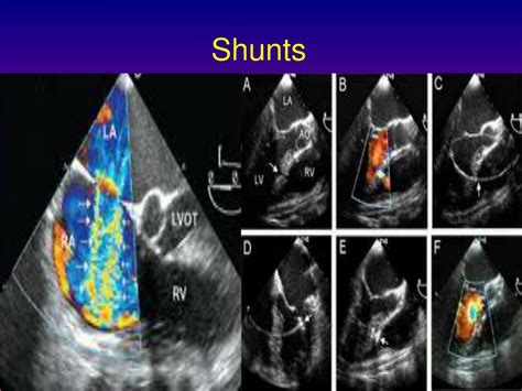 PPT - Basics of Echocardiography PowerPoint Presentation, free download - ID:1897076