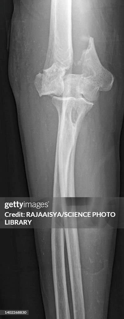 Supracondylar Fracture Xray High-Res Stock Photo - Getty Images